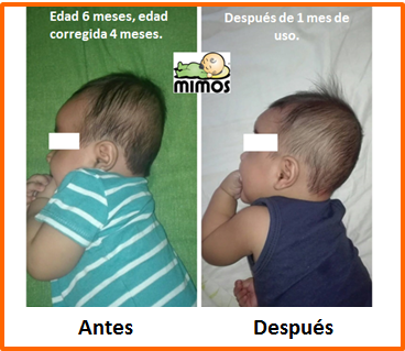 Cojin Mimos Mexico - El Cojín Mimos ayuda a prevenir la plagiocefalia  posicional (cabeza chueca) o cabeza plana de manera efectiva y segura desde  el nacimiento hasta los 18 meses. Además puede