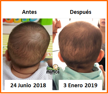 Cojin Mimos Mexico on X: Les compartimos esta historia maravillosa de este  bebé que empezó su tratamiento con el Cojin Mimos a los 8 meses, vemos como  se puede ver el cambio